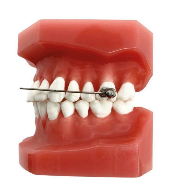 D2 Appliance Class Ii Corrector Toc Dental 1833